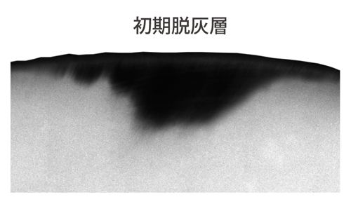 黒い部分はミネラルが溶け出し、歯の密度が薄くなっている状態。
